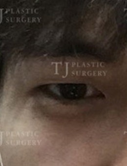 -韩国TJ整形外科：男士提肌+开外眼角+下至手术真实图片公开