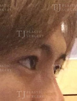 -韩国TJ整形外科：男士提肌+开外眼角+下至手术真实图片公开