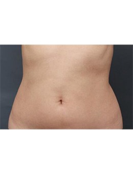 韩国N-slim吸脂医院腰腹吸脂，术后腰部紧实且线条流畅