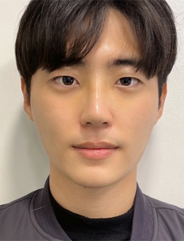 韩国乐日lara整形外科男神鼻打造手术日记，术后真的好帅！