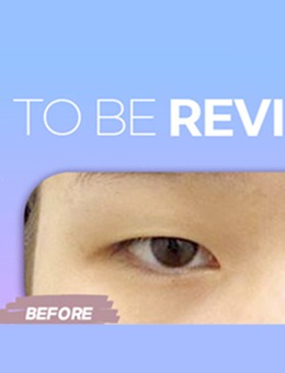 在韩国To Be整形做了眼部综合手术，前后对比照真的太惊人~