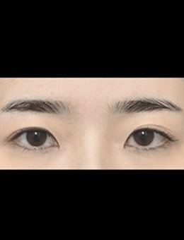 -韩国ICON整形医院埋线双眼皮修复开眼角恢复期、手术前后图片公布
