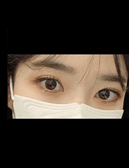 韩国ICON整形医院埋线双眼皮修复开眼角恢复期、手术前后图片公布_术后
