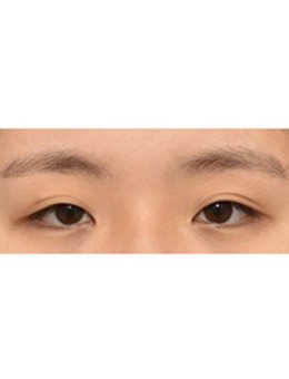 韩国ICON（图标）整形医院真人双眼皮开眼角提肌恢复图分享_术前