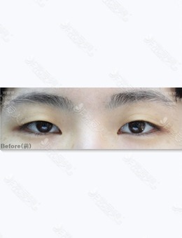 -韩国IOU整形外科全切开法双眼皮2周恢复期图片分享