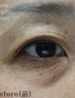 中老年眼睑下垂怎么治疗？眼眶凹陷祛眼袋有用吗，看图就懂_术前