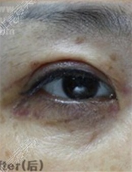 中老年眼睑下垂怎么治疗？眼眶凹陷祛眼袋有用吗，看图就懂_术后