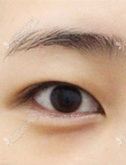 韩国自然粘连法双眼皮手术前后图片公开，纯素颜无滤镜~_术前