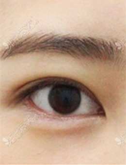 -韩国自然粘连法双眼皮手术前后图片公开，纯素颜无滤镜~