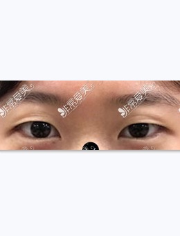 韩国美好MIHO整形外科：双眼皮眼部提肌图片对比分享