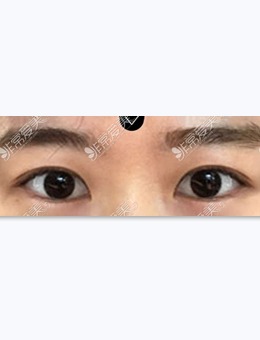 韩国美好MIHO整形外科：双眼皮眼部提肌图片对比分享_术后