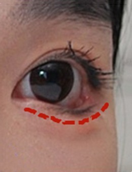 韩国来丽laree下眼睑下拉手术前后图片对比_术后