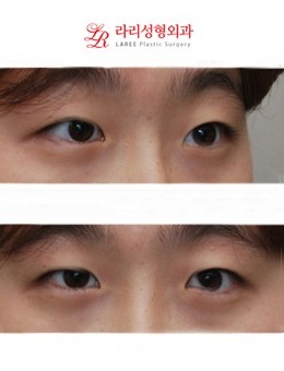 韩国来丽laree整形：眼综合4个月了还是肿，不存在的！