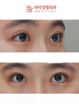 韩国来丽laree整形：眼综合4个月了还是肿，不存在的！