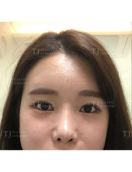 在韩国TJ整形外科做了眼鼻整形，改变从这里发生_术前