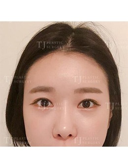 在韩国TJ整形外科做了眼鼻整形，改变从这里发生_术后