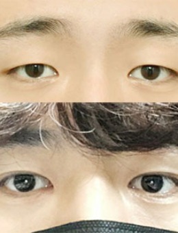 -韩国icon整形男士埋线双眼皮手术恢复效果分享！