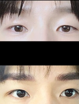 男士双眼皮前后对比照图片分享，韩国icon整形官方提供！_术前