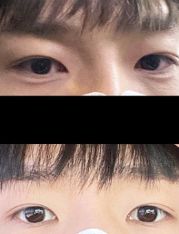 -男士双眼皮前后对比照图片分享，韩国icon整形官方提供！