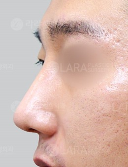 -韩国乐日lara整形外科男士鼻整形案例,变化不是一点点！