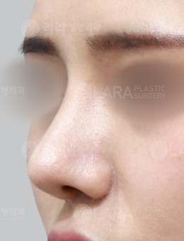 -韩国乐日lara整形外科鼻综合手术案例,精致微翘鼻超好看!