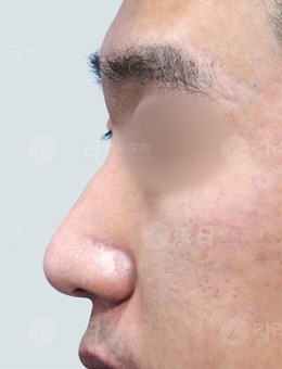 -韩国乐日lara整形外科男士鼻整形案例,变化不是一点点！
