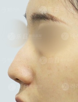 -韩国驼峰鼻矫正好的医院推荐乐日整形外科，案例对比明显！