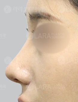 -韩国驼峰鼻矫正好的医院推荐乐日整形外科，案例对比明显！