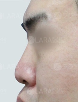 -韩国男士鼻整形案例,进行3d打印鼻部整形后变化巨大！