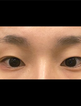 在韩国ICON整形外科做的眼睛真的太美了，很满意！