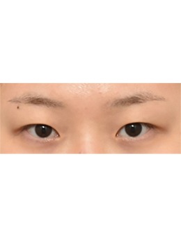 韩国ICON整形外科眼部整形很厉害,做完眼睛前后变化明显!