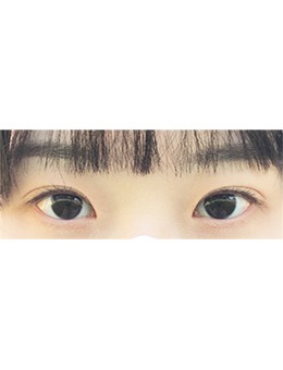 韩国ICON整形外科眼部整形很厉害,做完眼睛前后变化明显!