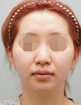 韩国整鼻子好的医院推荐得芘芘整形外科,隆鼻前后判若两人!