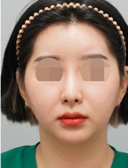 韩国整鼻子好的医院推荐得芘芘整形外科,隆鼻前后判若两人!_术后