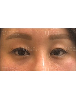韩国TJ整形眼睑提肌手术前后变化真大！