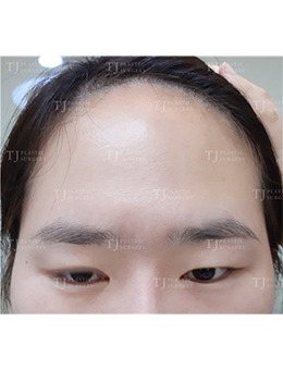 韩国TJ整形外科迷你提拉+自然黏连双眼皮手术前后对比照_术前