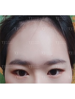 -韩国TJ整形外科迷你提拉+自然黏连双眼皮手术前后对比照