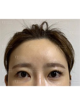 -韩国TJ整形外科眼部整形前后变化太大了,简直像换了一个人!