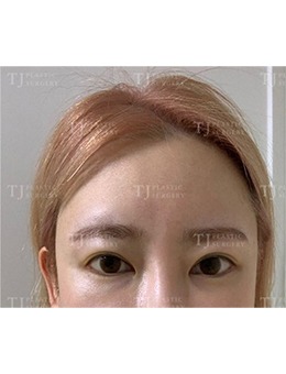 韩国TJ整形外科眼部整形前后变化太大了,简直像换了一个人!_术后