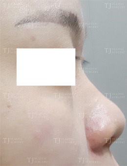 打卡韩国TJ整形特色隆鼻，术后360°无死角高挺立体鼻！