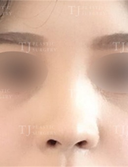 -韩国TJ整形外科鼻翼缩小术前术后对比，摇身一变韩国欧尼！