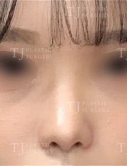 韩国TJ整形外科鼻翼缩小术前术后对比，摇身一变韩国欧尼！_术后