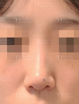 韩国TJ整形外科隆鼻特色详解，主打自然隐痕妈生鼻！_术前