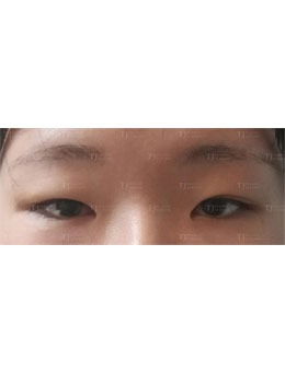 在韩国TJ整形做的切开双眼皮+开眼角手术，术后太有灵气了！_术前