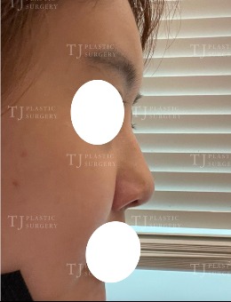隆鼻手术前后图分享，韩国TJ整形隆鼻好口碑不是白来的！_术前