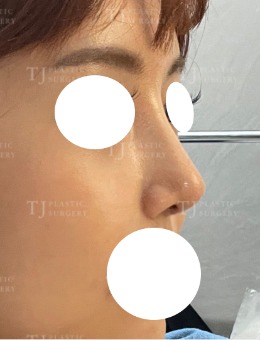 隆鼻手术前后图分享，韩国TJ整形隆鼻好口碑不是白来的！_术后