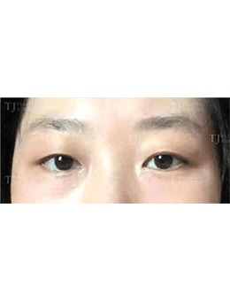 韩国TJ整形做切开双眼皮真的看不到疤痕，闭眼照片你来看！