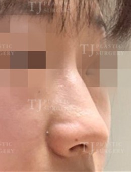 韩国TJ整形隆鼻术后恢复过程图，从照片中看恢复期超级短！_术前