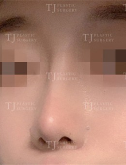 韩国TJ整形隆鼻术后恢复过程图，从照片中看恢复期超级短！_术后