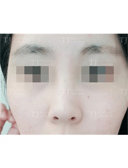 韩国TJ整形鼻翼缩小术前术后对比图，变化很明显！_术前